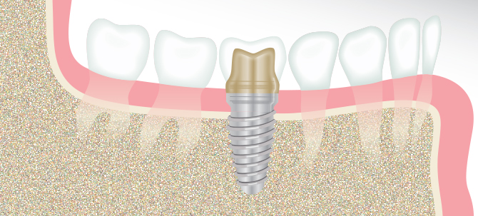 Dental Implants